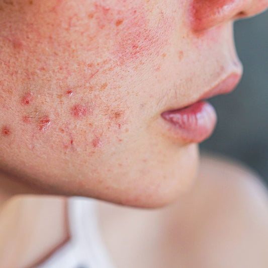 How can Tea Tree Oil help get rid of acne?